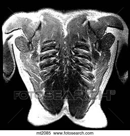 Stock Illustration - Thorax - Coronal. Fotosearch