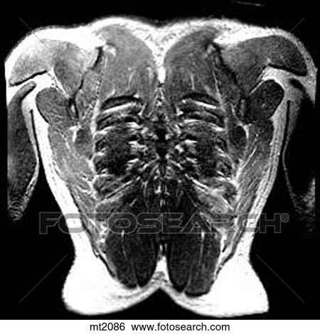 Stock Illustration - Thorax - Coronal. Fotosearch