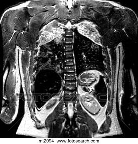 Stock Illustration - Thorax - Coronal. Fotosearch