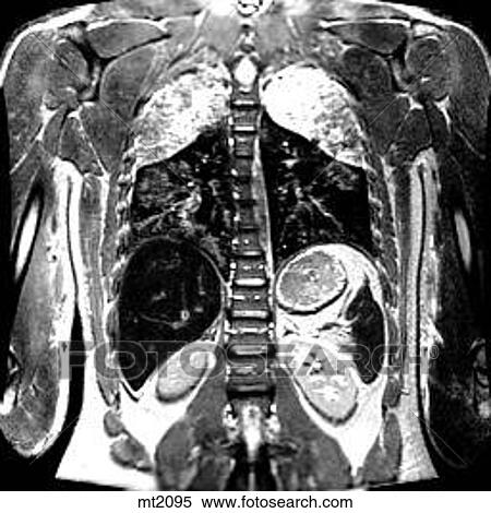 Thorax - Coronal View Large Illustration Stock Illustration - Thorax - Coronal. Fotosearch
