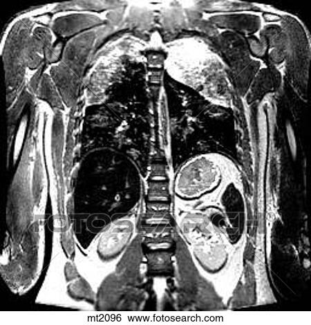 Thorax - Coronal View Large Illustration Stock Illustration - Thorax - Coronal. Fotosearch