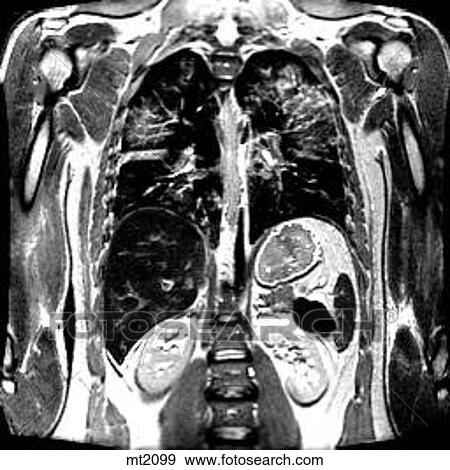 Stock Illustration - Thorax - Coronal. Fotosearch