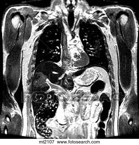 Stock Illustration - Thorax - Coronal. Fotosearch
