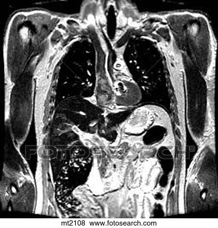 Thorax - Coronal View Large Illustration Stock Illustration - Thorax - Coronal. Fotosearch