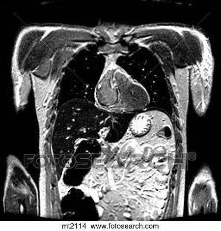 Thorax - Coronal View Large Illustration Stock Illustration - Thorax - Coronal. Fotosearch