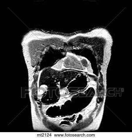 Stock Illustration - Thorax - Coronal. Fotosearch