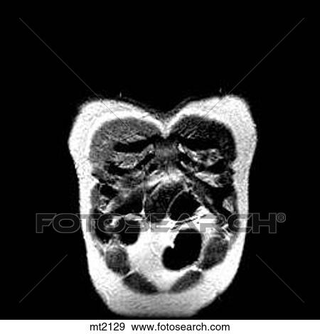 Stock Illustration - Thorax - Coronal. Fotosearch