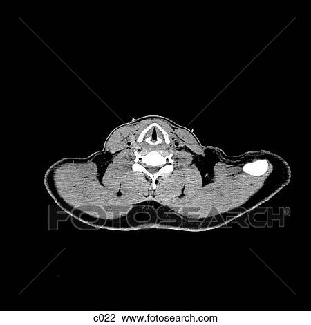 Thorax View Large Illustration Drawing - Thorax. Fotosearch