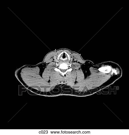 Thorax View Large Illustration Drawing - Thorax. Fotosearch