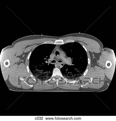 Thorax View Large Illustration Drawing - Thorax. Fotosearch