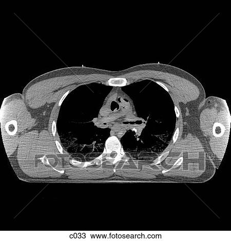 Thorax View Large Illustration Drawing - Thorax. Fotosearch