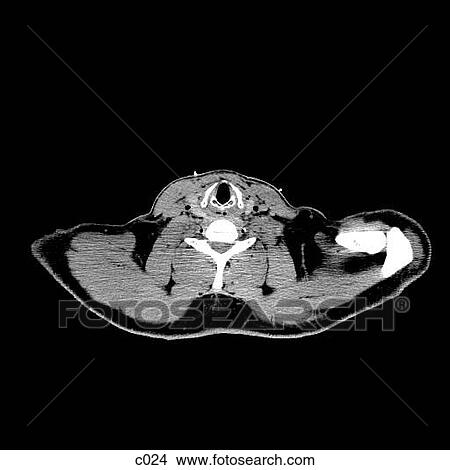 Stock Illustration - Thorax. Fotosearch