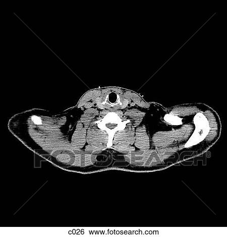 Stock Illustration - Thorax. Fotosearch