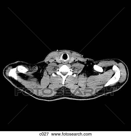 Thorax View Large Illustration Stock Illustration - Thorax. Fotosearch