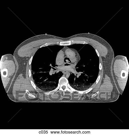 Thorax View Large Illustration Stock Illustration - Thorax. Fotosearch