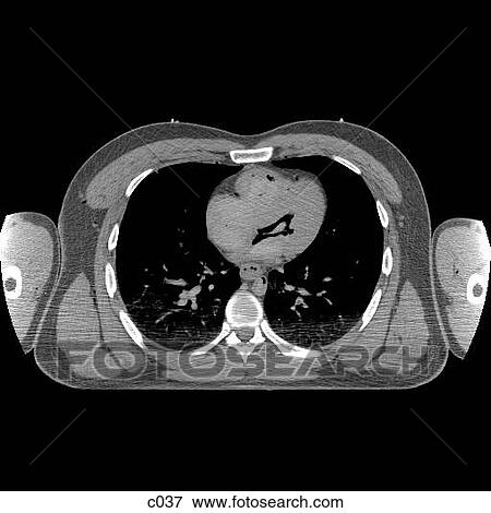 Thorax View Large Illustration Stock Illustration - Thorax. Fotosearch