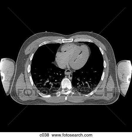 Thorax View Large Illustration Stock Illustration - Thorax. Fotosearch