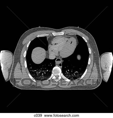 Thorax View Large Illustration Stock Illustration - Thorax. Fotosearch