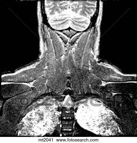 Upper Body - Coronal View Large Illustration Clip Art - Upper Body - Coronal. Fotosearch