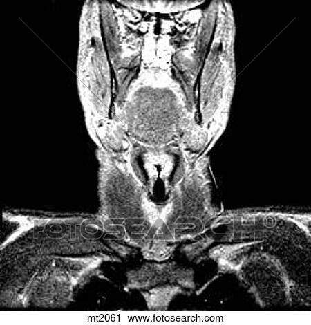 Upper Body - Coronal View Large Illustration Clip Art - Upper Body - Coronal. Fotosearch