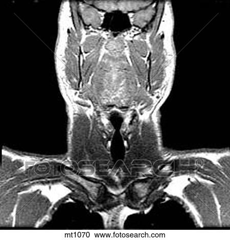 Clipart - Upper Body - Coronal. Fotosearch