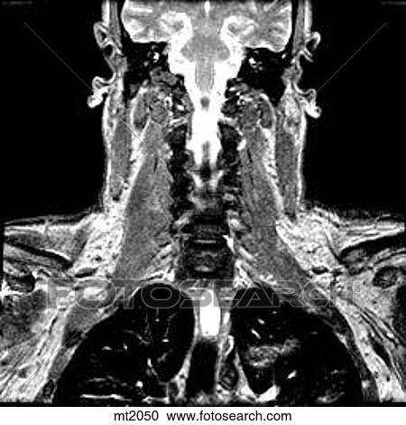 Clipart - Upper Body - Coronal. Fotosearch