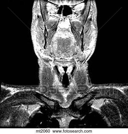 Clipart - Upper Body - Coronal. Fotosearch