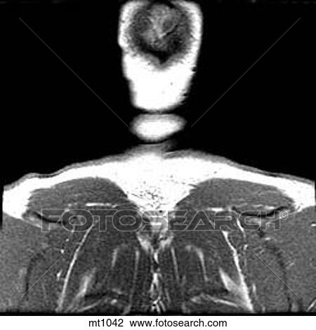 Drawing - Upper Body - Coronal. Fotosearch