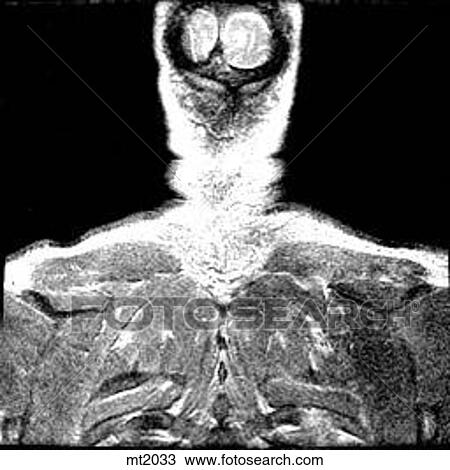 Drawing - Upper Body - Coronal. Fotosearch