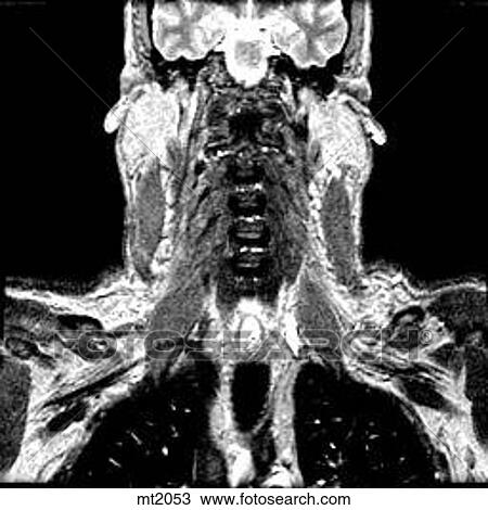 Drawing - Upper Body - Coronal. Fotosearch
