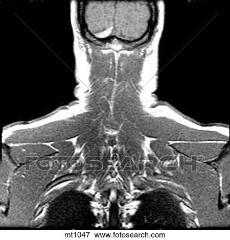 Stock Illustration - Upper Body - Coronal. Fotosearch