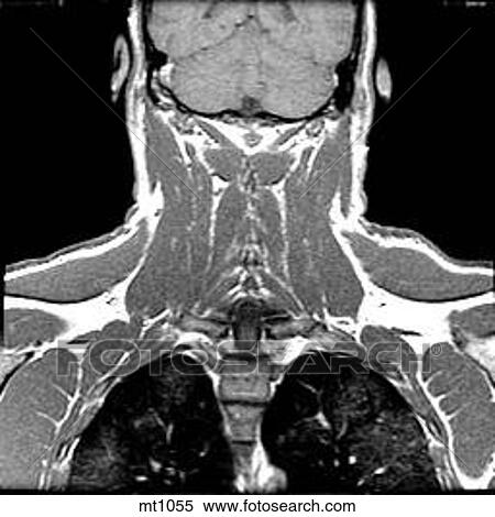Stock Illustration - Upper Body - Coronal. Fotosearch