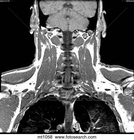 Upper Body - Coronal View Large Illustration Stock Illustration - Upper Body - Coronal. Fotosearch