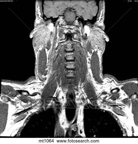Upper Body - Coronal View Large Illustration Stock Illustration - Upper Body - Coronal. Fotosearch