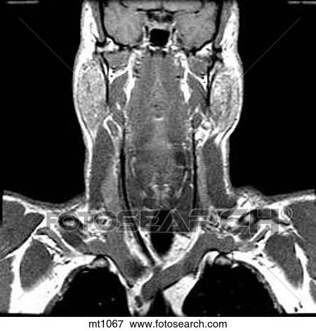Stock Illustration - Upper Body - Coronal. Fotosearch