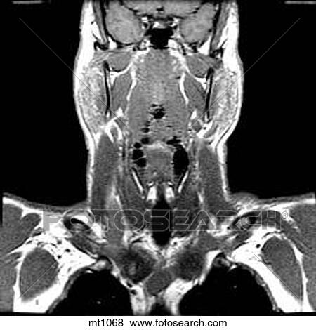Stock Illustration - Upper Body - Coronal. Fotosearch