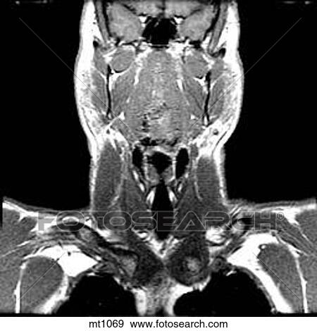 Stock Illustration - Upper Body - Coronal. Fotosearch