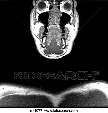 Stock Illustration - Upper Body - Coronal. Fotosearch