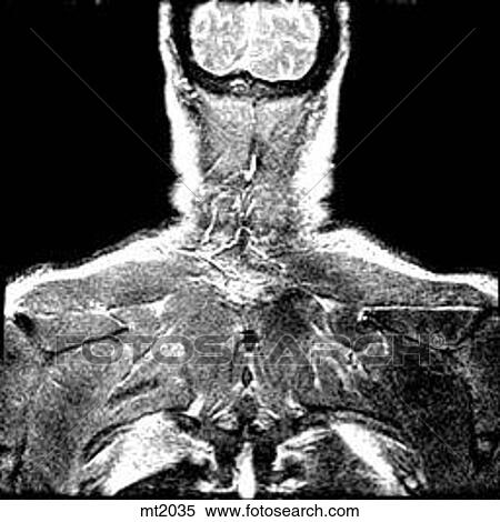 Stock Illustration - Upper Body - Coronal. Fotosearch