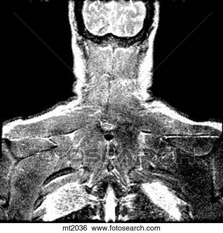 Stock Illustration - Upper Body - Coronal. Fotosearch