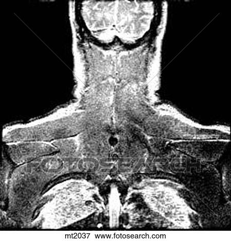 Stock Illustration - Upper Body - Coronal. Fotosearch