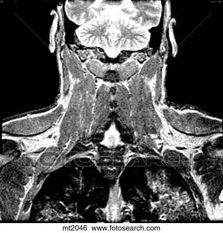 Upper Body - Coronal View Large Illustration Stock Illustration - Upper Body - Coronal. Fotosearch