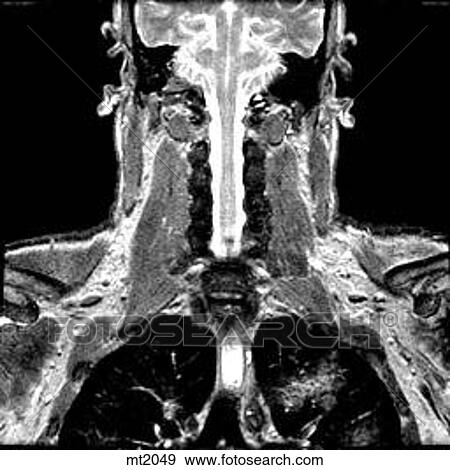 Stock Illustration - Upper Body - Coronal. Fotosearch