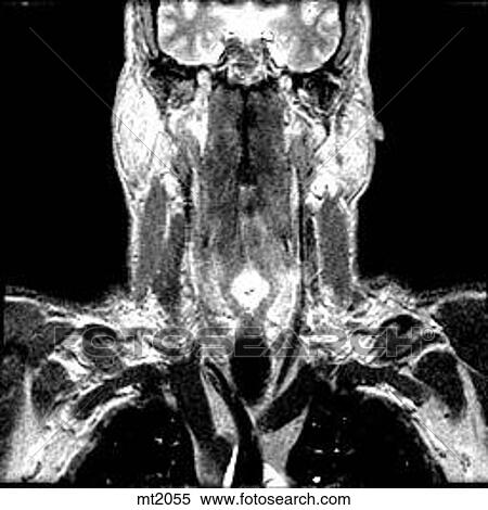 Stock Illustration - Upper Body - Coronal. Fotosearch