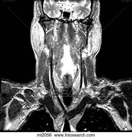 Upper Body - Coronal View Large Illustration Stock Illustration - Upper Body - Coronal. Fotosearch