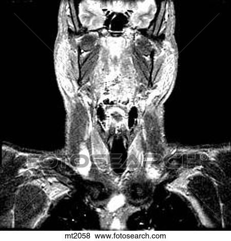 Upper Body - Coronal View Large Illustration Stock Illustration - Upper Body - Coronal. Fotosearch