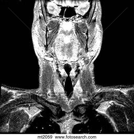 Stock Illustration - Upper Body - Coronal. Fotosearch