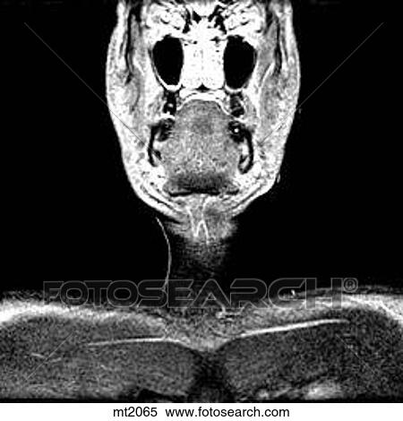 Stock Illustration - Upper Body - Coronal. Fotosearch