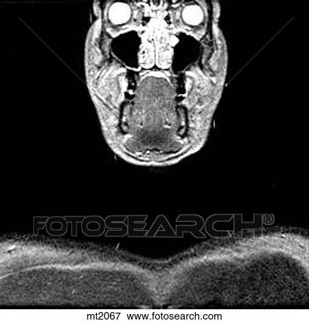 Stock Illustration - Upper Body - Coronal. Fotosearch