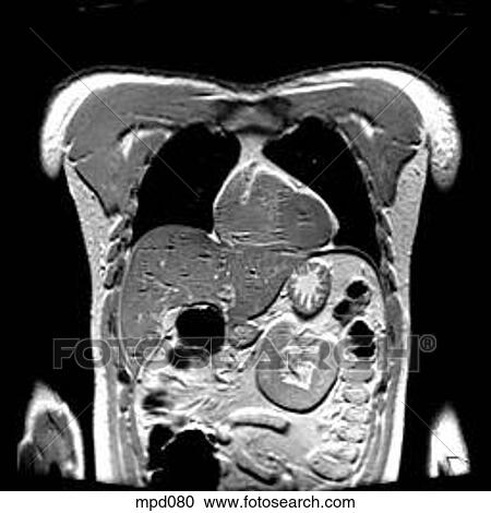 Upper Torso - Coronal View Large Illustration Clipart - Upper Torso - Coronal. Fotosearch